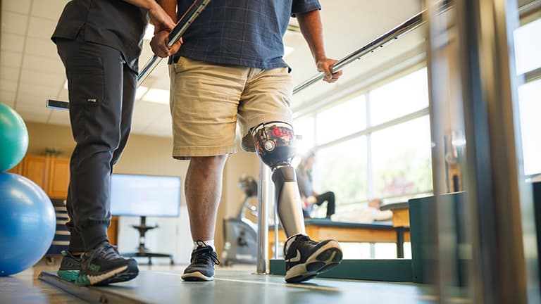 Man with amputated leg practices walking in between two bars alongside therapist.