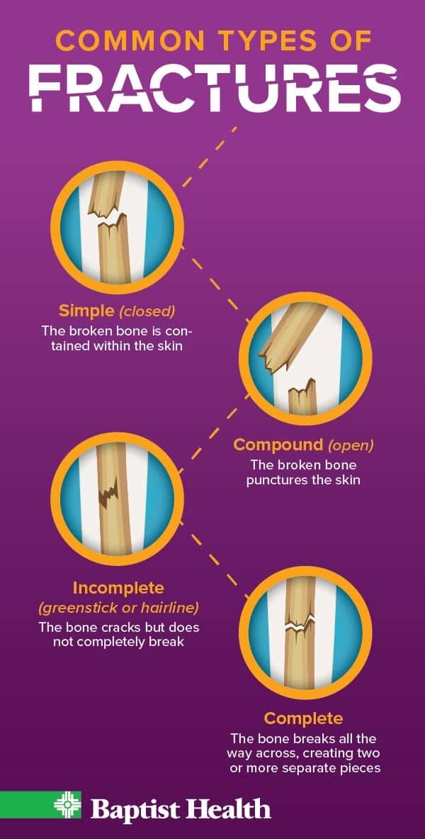 Infographic explaining the different types of bone fractures